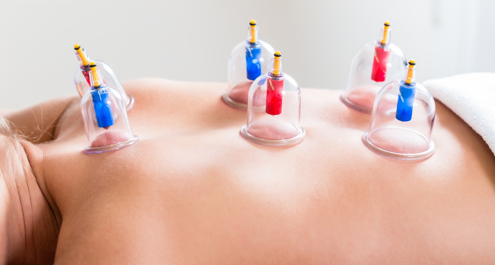 Cupping Therapy at Dr. Onkar's Clinic