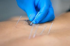 Dry Needling at Dr. Onkar's Clinic